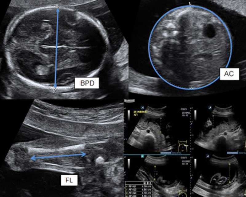 detailed scan ultrasound cheras