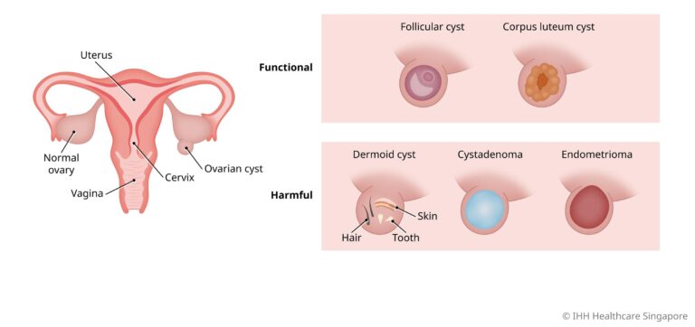 Apa Beza Cyst dan Fibroid – Punca Sakit Rahim 5 ovarian cyst