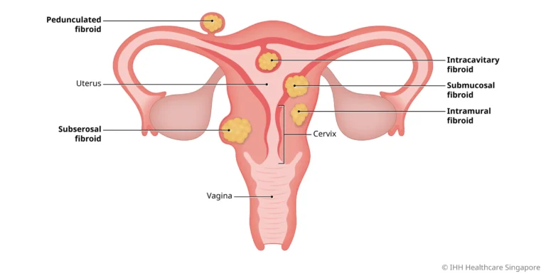 Apa Beza Cyst dan Fibroid – Punca Sakit Rahim 6 fibroid