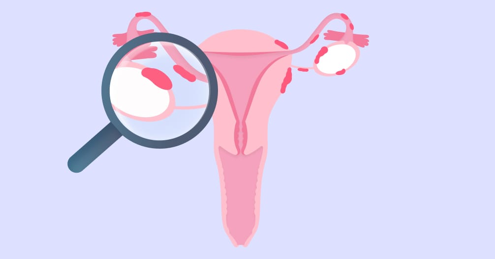 endometriosis