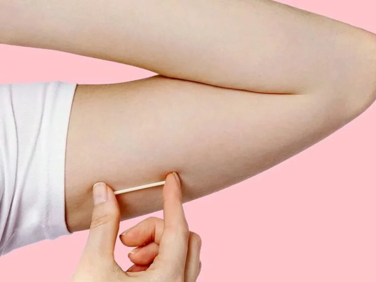 Family Planning & Contraception 9 implante hormonal implanon
