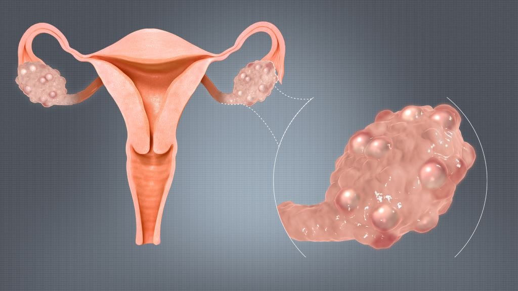 Polycystic Ovaries Scientific Animations wiki 1024